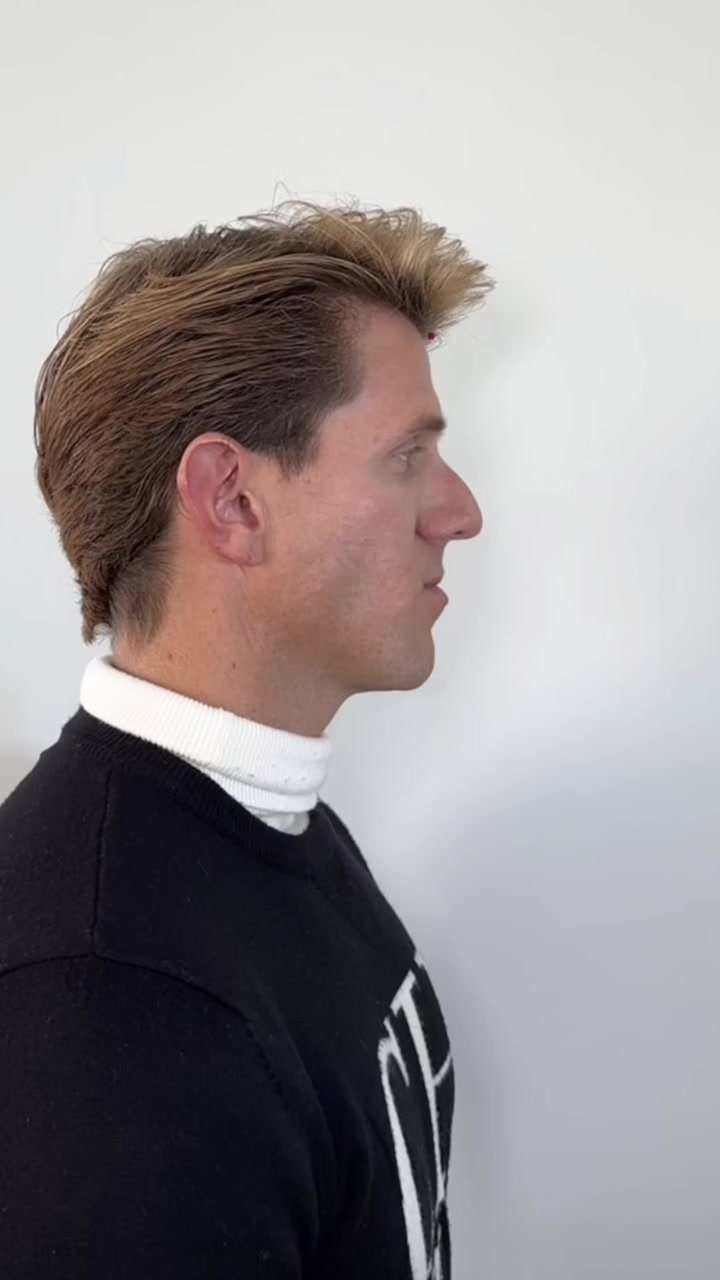 Fotograma del perfil de un paciente en una publicación sobre armonización facial del Dr. Bidot.